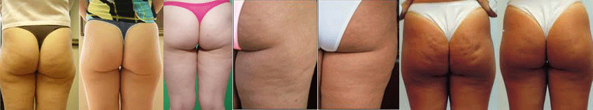 How to get rid of cellulite fast